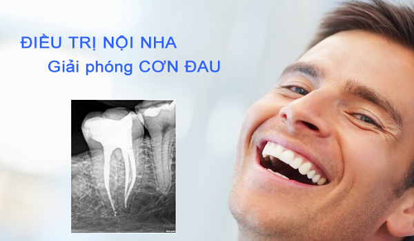 Điều trị nội nha