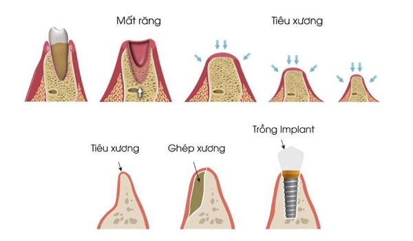 Cấy ghép Implant giúp ngăn ngừa tình trạng tiêu xương